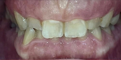 Patient smile before treatment
