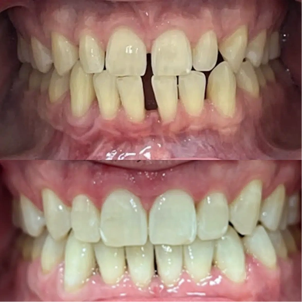 Real Smile Vegas Dental patient: teeth with gaps before treatment, gaps closed after treatment