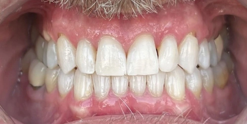 Patient teeth after whitening treatment