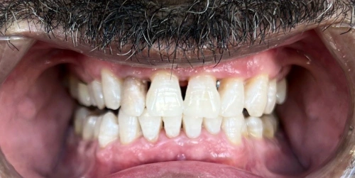 The same patient's teeth after ZOOM whitening at Smile Vegas Dental