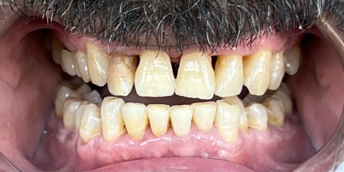 Patient's teeth before ZOOM whitening at Smile Vegas Dental