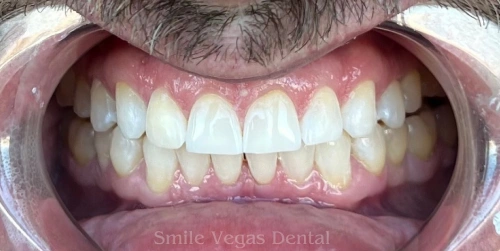 The same patient's teeth after Invisalign at Smile Vegas Dental