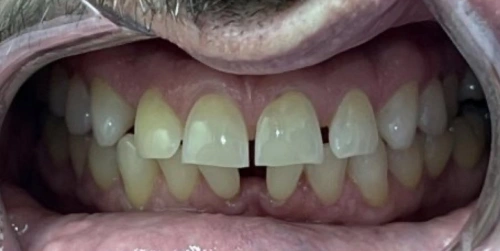 Patient's teeth before Invisalign at Smile Vegas Dental