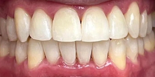 The same patient's smile after overbite care at Smile Vegas Dental