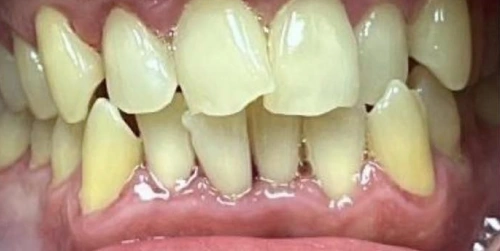 Patient's overbite before care at Smile Vegas Dental
