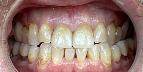 The same patient's tooth after a porcelain crown at Smile Vegas Dental