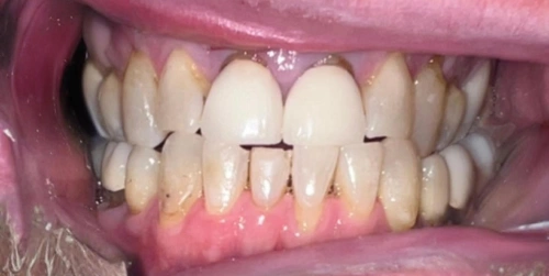 Patient's tooth before a porcelain crown at Smile Vegas Dental