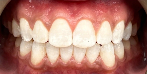 The same patient's smile after their transformation at Smile Vegas Dental