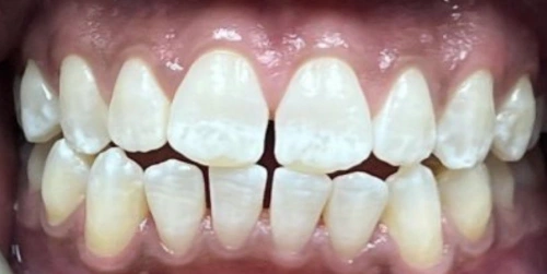 Patient's smile before their transformation at Smile Vegas Dental