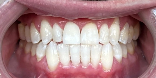 The same patient's smile after underbite care at Smile Vegas Dental