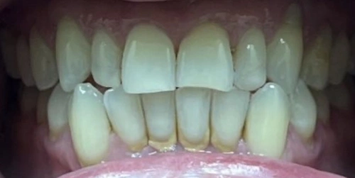 Patient's underbite before care at Smile Vegas Dental